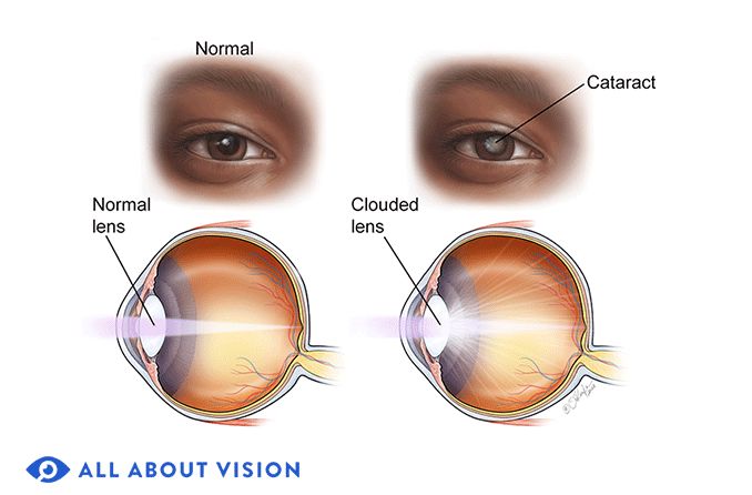 normal eye vs eye with cataract
