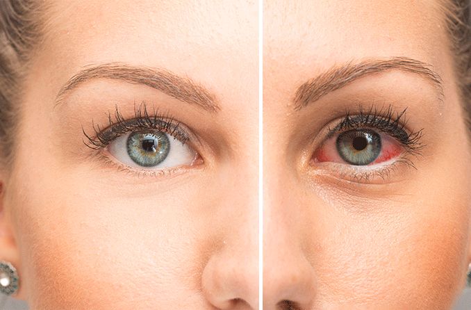 side by side image of normal eye vs dry eye