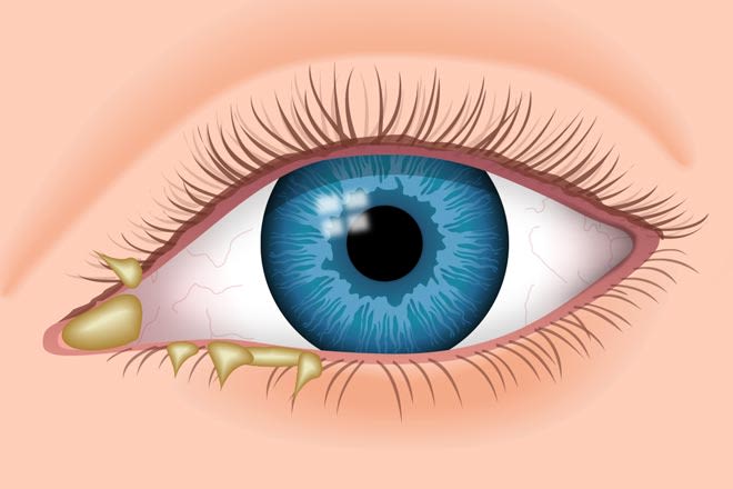 illustration of eye discharge