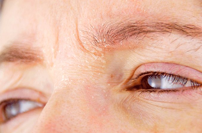 closeup of eyelids and eyebrows with dry skin