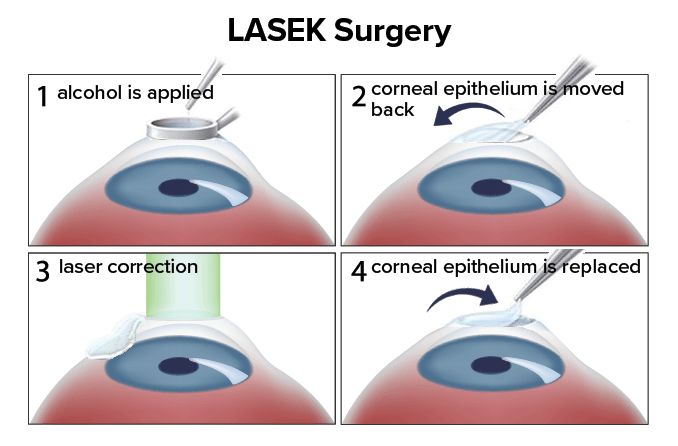 lasek surgery steps