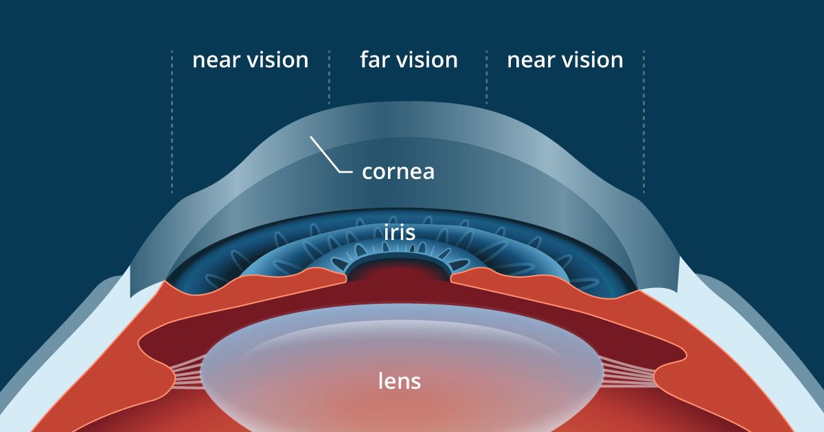 illustration of cornea profile after presbyLASIK