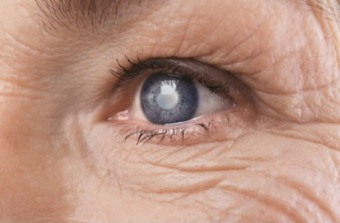 Person with Cataracts