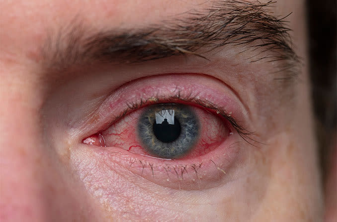 man with swollen eyelid / blepharitis